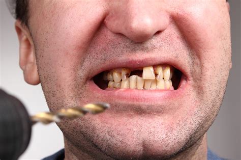 Bad Teeth Can Affect Your Mental Health