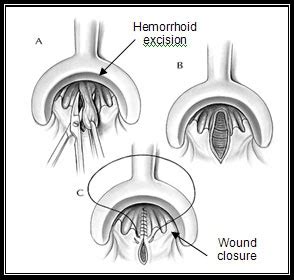 General Surgery Hemorrhoidectomy