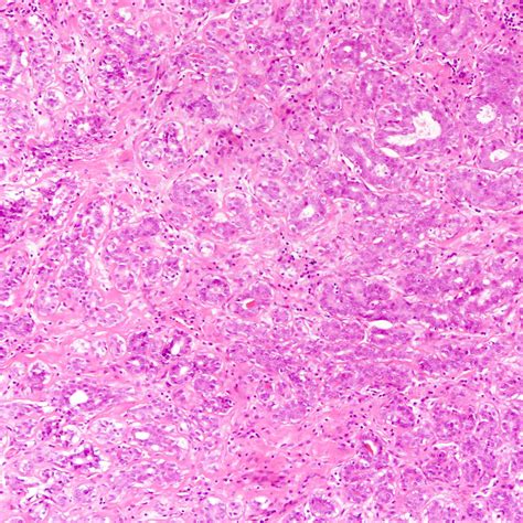 Pathology Outlines Tubular Adenoma