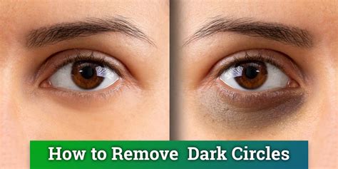 Dark Circles Under Your Eyes—causes And Treatment Western