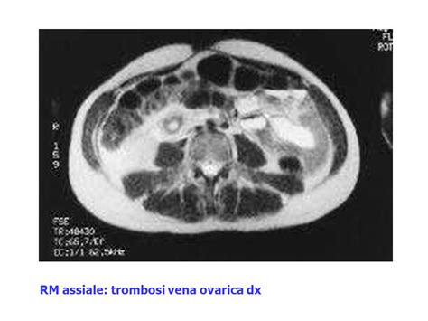 Pielonefrite xantogranulomatosa effettuando una tac o una risonanza magnetica è post pielonefrite buonasera,circa 4 mesi fa sono stata dimessa dall'ospedale per pielonefrite rene sinistro. TROMBOSI VENOSE PELVICHE E LE ALTRE SEDI UROGINECOLOGICHE ...
