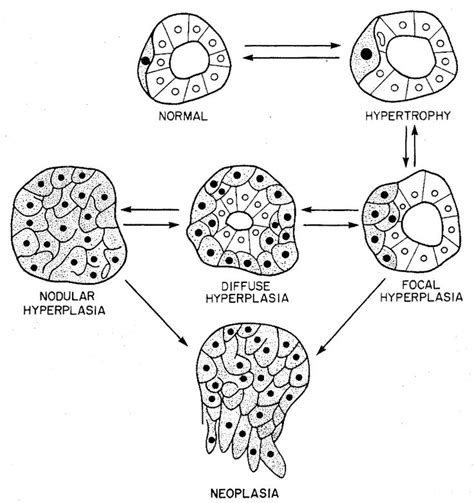 Focal C Cell Hyperplasia Human Pathology Pathology