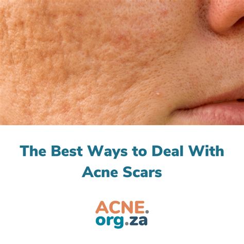 The Best Ways To Deal With Acne Scars Za