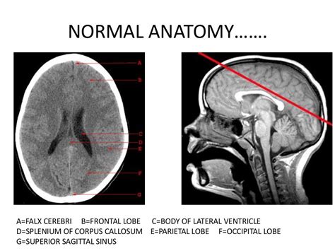 Basics Of Ct Head