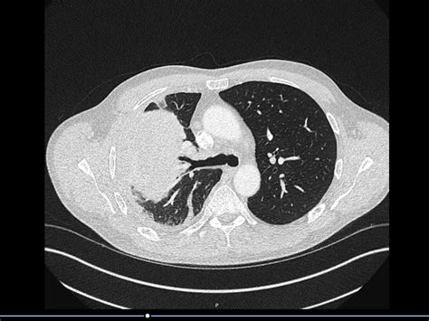 Ct Thorax Axial Image Lung Window Showing Right Middle Lobe