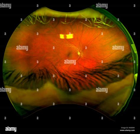 Un Ultra Wide Scan Digital De Retina De Un Ojo Humano Mostrando Las