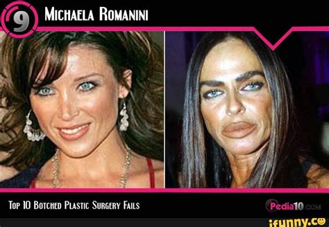 Top 10 Botched Plastic Surgery Fails Before And After Toe 10 Botcuen Prastic Surgery Fails
