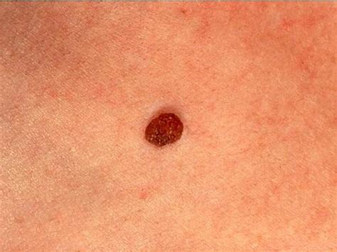 Moles Have Well Defined Borders Skin Cancer Or Mole How To Tell