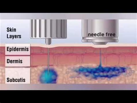 The hyaluronic pen is a device that has a piston with a spring that provides a quick administration of hyaluronic acid into your skin. Hyaluron Pen Injection without needle ...