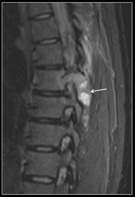 Sagittal Stir Mri Of The Thoracic Spine Showing A Tumour Arrow Within