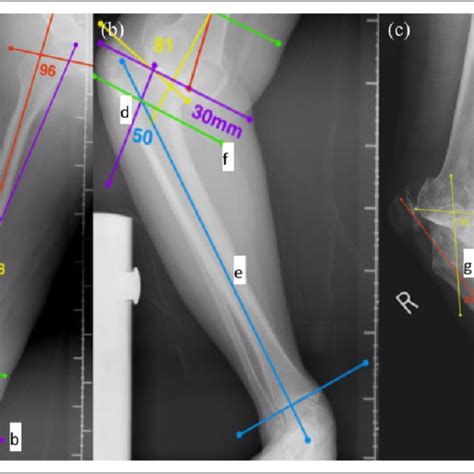 Preoperative Planning For Femoral And Tibial Deformity Correction A