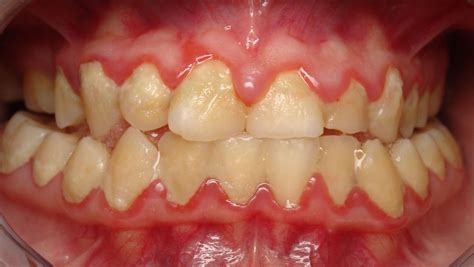Plaque And Your Teeth Waverley Oaks Dental