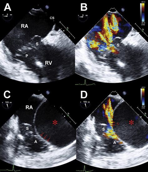 Impact Of Intraoperative Transesophageal Echocardiography For