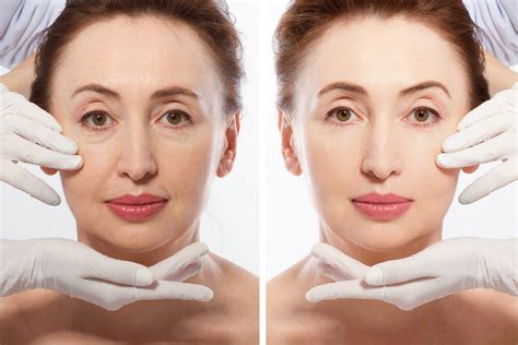 What Should You Know About Neck Lift Surgery