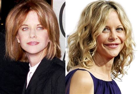 Meg Ryan Before And After Plastic Surgery Celebrity Plastic