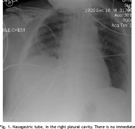 Figure 1 From Thoracic Complications Of Nasogastric Tube Review Of