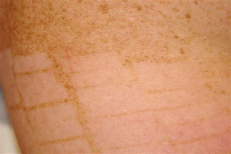 Exploring The Cost Of Laser Treatment For Freckles In India Risks And Benefits Justinboey