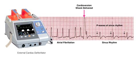 Electrical Cardioversion One Heart Cardiology