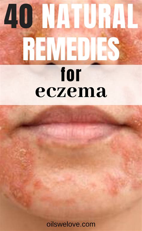 40 Natural Eczema Treatments And Remedies Natural Eczema Treatment