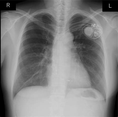 Chest Radiography After Dual‐chamber Pacemaker Implantation Download