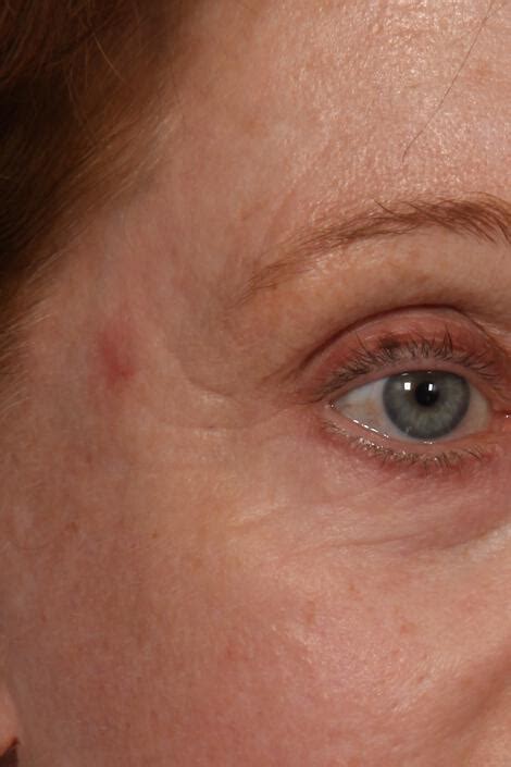 Wrinkle Reduction Gallery Before And After Patient 22 Marina Medspa