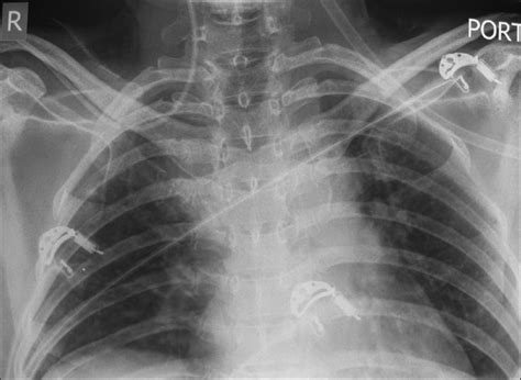 A Triple Lumen Cvc Inserted Via Right Subclavian Vein With The Tip