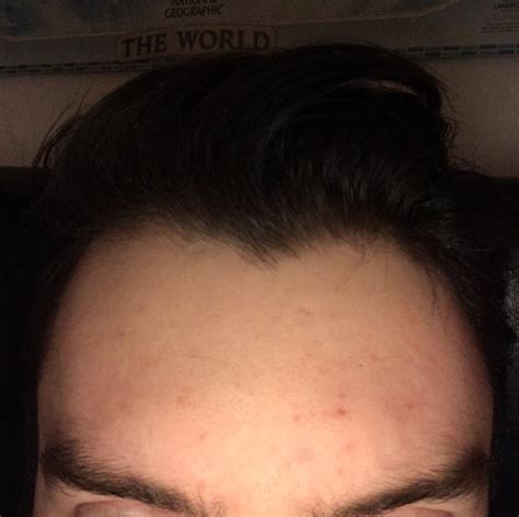 Skin Concerns Im Mostly Happy With My Skin But My Forehead Has