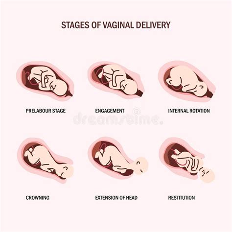 Stage Of Vaginal Delivery Flat Illustration Stock Vector Illustration