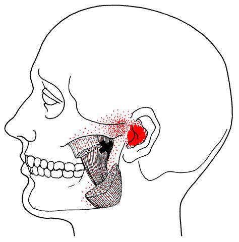 Jaw Pain And Trigger Points Body Heal Therapy