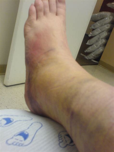 Days Sprained Ankle Crazy Bruising And Swelling From Flickr