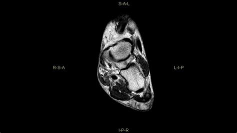 Ruptured Anterior Tibial Tendon Complete Mri Examination Youtube