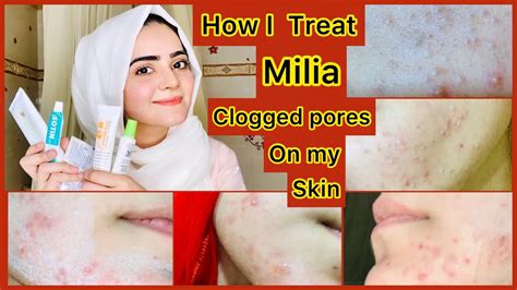 How To Treat Milia Clogged Pores Permanently At Home Self