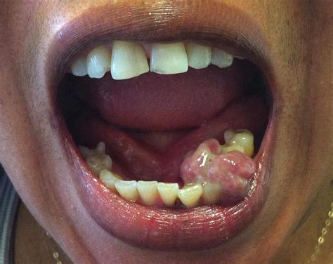 Mouth Cancer And Pre Malignant Conditions Mr Luke Cascarini