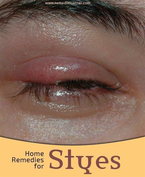 Home Remedies For Styes Pin Remedies Skin Tags Home Remedies Home