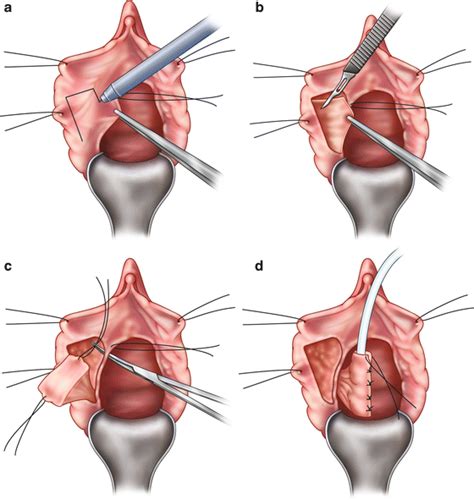 Urethroplasty For Female Urethral Stricture Obgyn Key