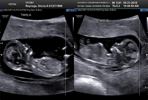 12 Weeks Ultrasound Twiniversity
