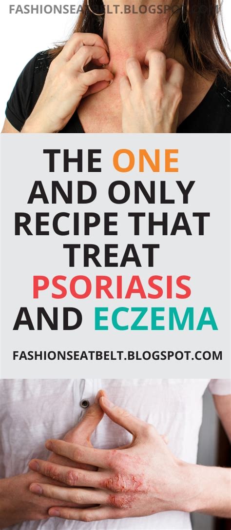 The One And Only Recipe That You Need To Treat Psoriasis And Eczema