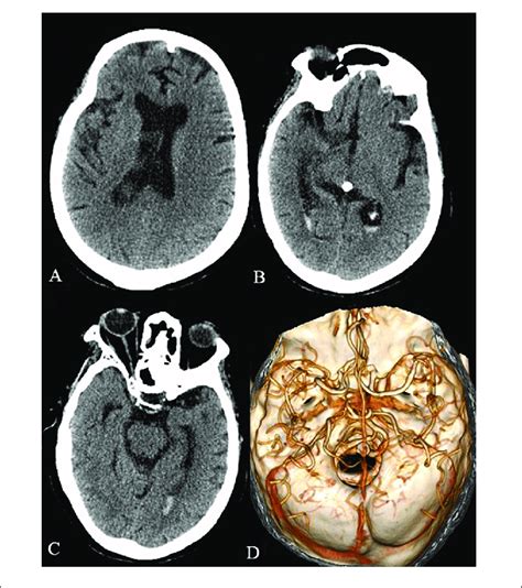 The Head Ct And Cta 1 Month After The Operation Of The Download