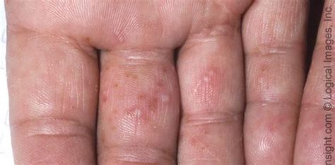 Dyshidrotic Hand Dermatitis Dorothee Padraig South West Skin Health Care