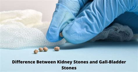 Difference Between Kidney Stones And Gall Bladder Stones