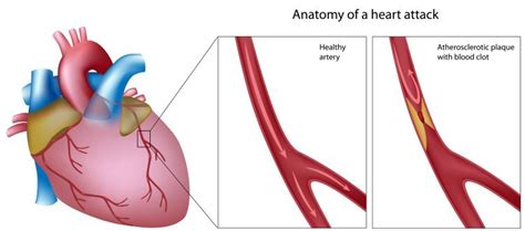 Acute Coronary Syndrome Explained By A Cardiologist • Myheart