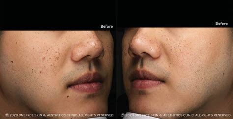 freckles removal treatment by laser patient s experience in singapore 2022