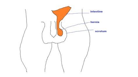 What is the inguinal region? Inguinal Hernia | Pediatric Surgery