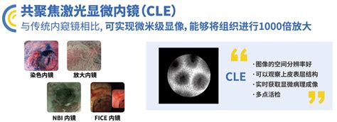 Confocal Laser Endomicroscopy