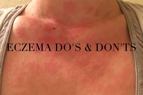 Nutritional Nutcase Eczema Medical Tattoo Quotes