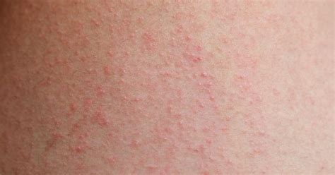 Eczema Causes Symptoms And Treatments