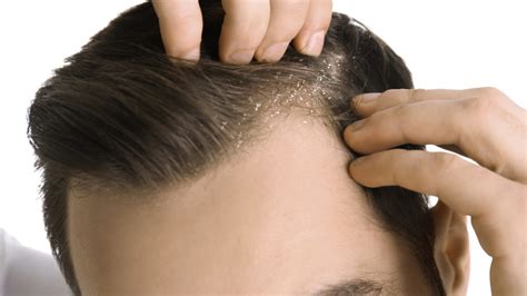 Scalp Corrective Treatment Hair Loss Treatment