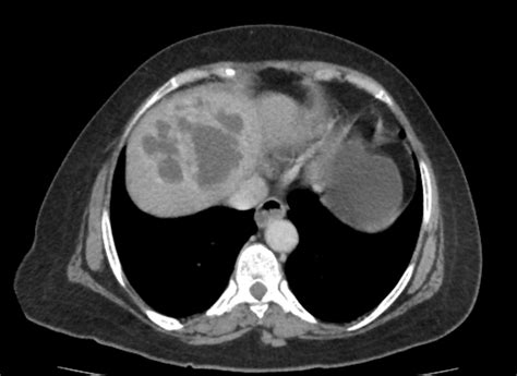 Liver Abscess Radiopaedia