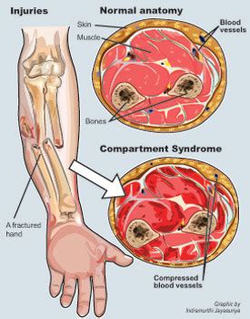 ATI Med Surg Ch 35 Peripheral Vascular Disease Flashcards Quizlet