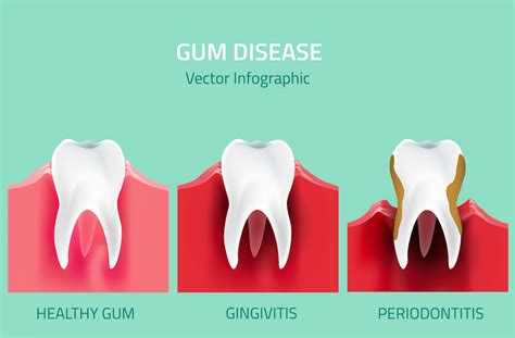 how to tell if you have gum disease dr kevin sands